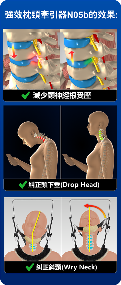 頸椎神經受壓