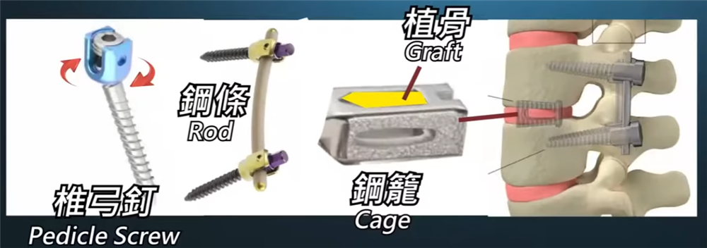 後路脊椎融合手術