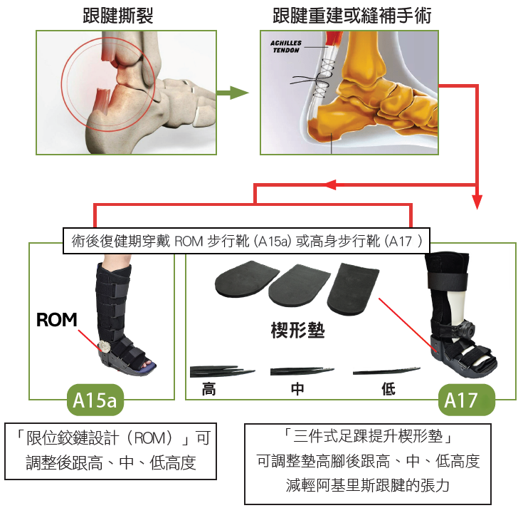 阿基里斯跟腱術後 ROM 步行靴及高身步行靴示意圖